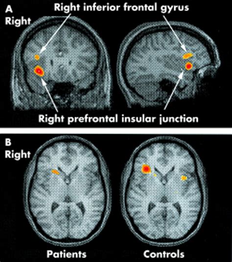 A Study Of Persistent Post Concussion Symptoms In Mild Head Trauma