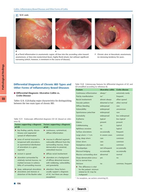 Differential Diagnosis Of Chronic Ibd Types And Ot Inflammatory Bowel