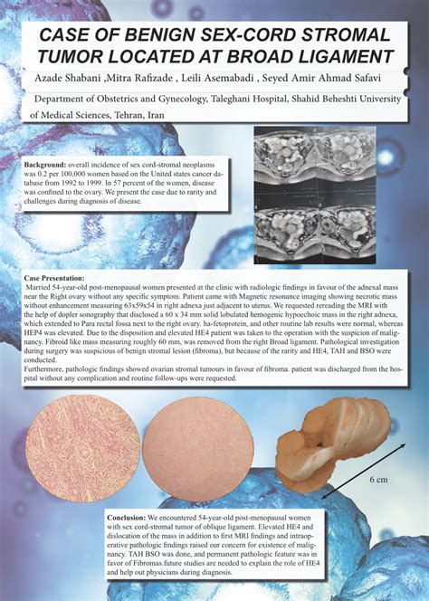 Pdf Case Of Benign Sex Cord Stromal Tumor Located At Broad Ligament