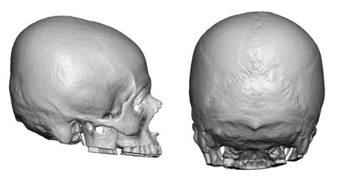 Blog Archivecase Study Flat Back Of Head Skull Implant