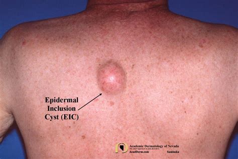 Epidermal Inclusion Cysts Eic Epidermoid Cysts Academic