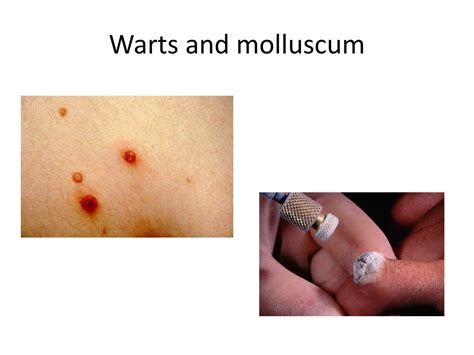 Ppt Skin Infections And Infestations Powerpoint Presentation Free