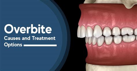 What Is An Overbite Symptoms Treatment And More