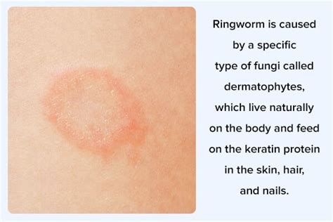 Ringworm Alopecija U Djece Metode Prevencije I Liječenja Najbolji Dom