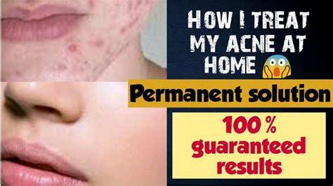 how to remove pimples overnight acne treatment diy 100 results guaranteed youtube