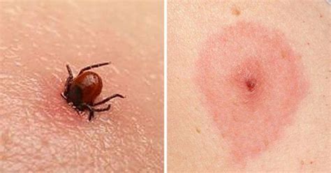 Here Are 8 Common Bug Bites And How You Can Recognize Them