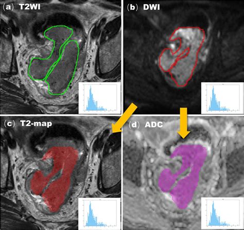 An Example Of Manual Segmentation Of Mri In The Primary Tumor Of Rectal