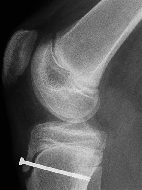 Complete Resolution Of The Symptoms Of Refractory Osgood Schlatter