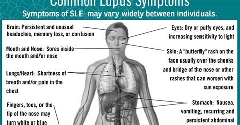 What Are The Signs And Symptoms Of Lupus