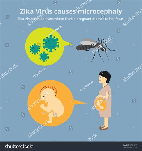 Zika Virus Causes Microcephaly The Virus Is Transmitted By Mosquitos