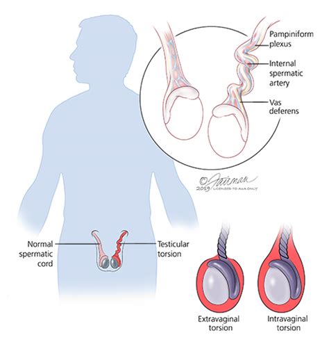 Testicular Torsion Symptoms Diagnosis Treatment Urology Care