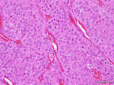 Metastasis Of A Malignant Leydig Cell Tumour An Unusual Presentation