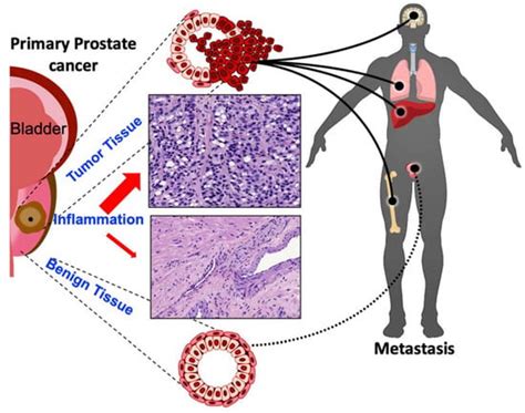 Cancers Free Full Text Inflammation As A Driver Of Prostate Cancer