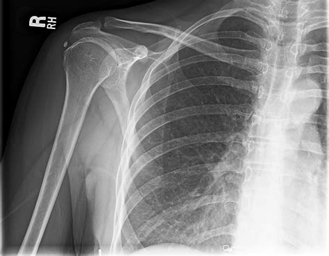 Ortho Dx: Sudden Onset Shoulder Pain - Clinical Advisor