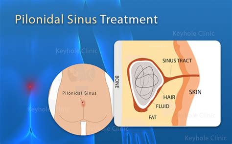Pilonidal Sinus Treatment In Kochi Keyhole Clinic