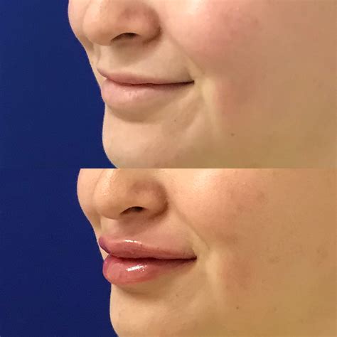Restylane Kysse Lips Before And After
