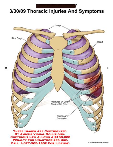 Thoracic Injuries And Symptoms