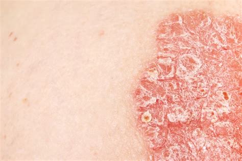 Psoriasis Psoriatic Skin Disease — Stock Photo © Lipowski 116458272