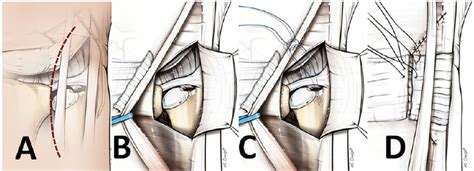 A tfcc tear can be used by the tfcc is made of tough fibrous tissue and cartilage. c). Drawing showing the open procedure to repair the TFCC ...