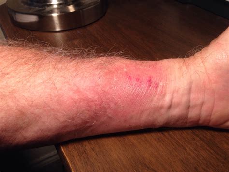 Wrist Rash Truly One Foot In Front Of The Other Pct Edition