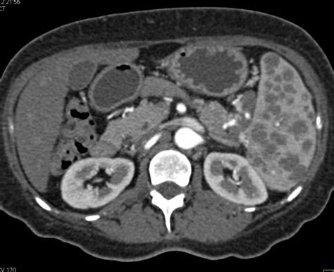 Sarcoidosis With Splenic Lesions And Para Aortic Adenopathy Spleen