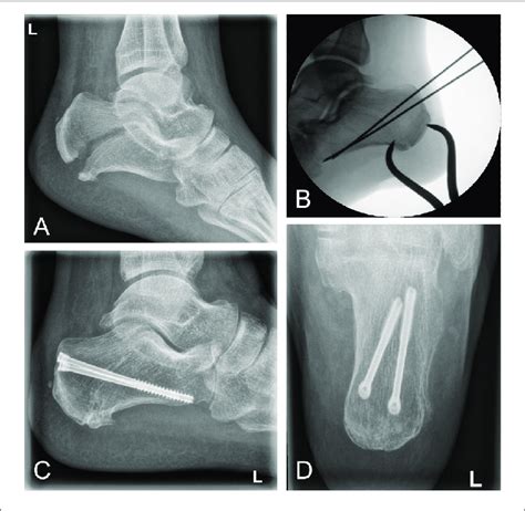 Clinical Case Of A Calcaneal Avulsion Fracture Successfully Treated