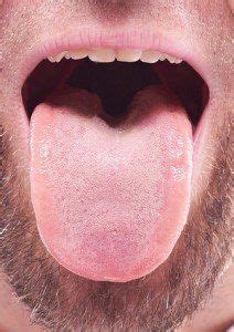 Fat Tongue Could Play A Role In Sleep Apnea