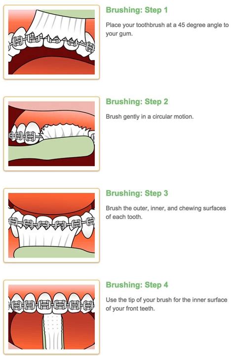 Brush the outer surfaces of your teeth and braces, remembering to scrub around each bracket and over its surfaces. how to brush your teeth with braces - Google Search ...