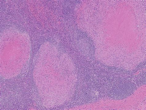 Reactive Lymph Node Conditions In Childhood Diagnostic Histopathology