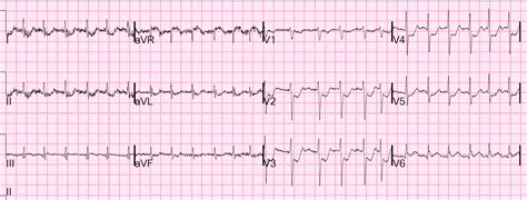 Dr Smiths Ecg Blog Atrial Fibrillation W Rapid Ventricular Response