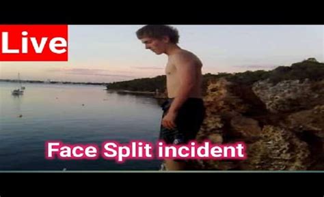 Split Face Diving Accident The Shocking Story Of A Teenager Who