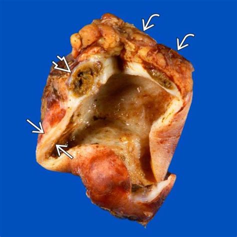 They may be microscopic or macroscopic. Xanthogranulomatous Cholecystitis | Radiology Key