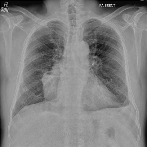 Erect Chest Xray PA View Done Preoperatively Showing An Opacity Along