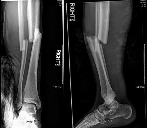 A 26 Year Old Man With Disorientation Following Leg Fracture Jbjs