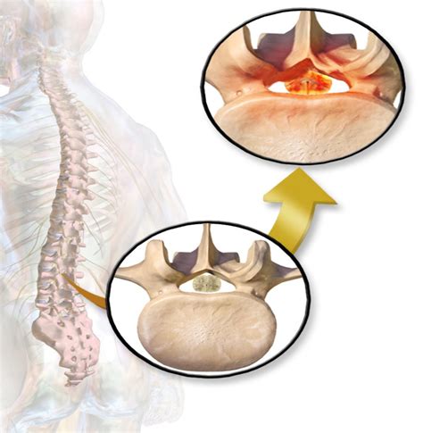 Minimally Invasive Lumbar Decompression Procedure Mild Empire Spine