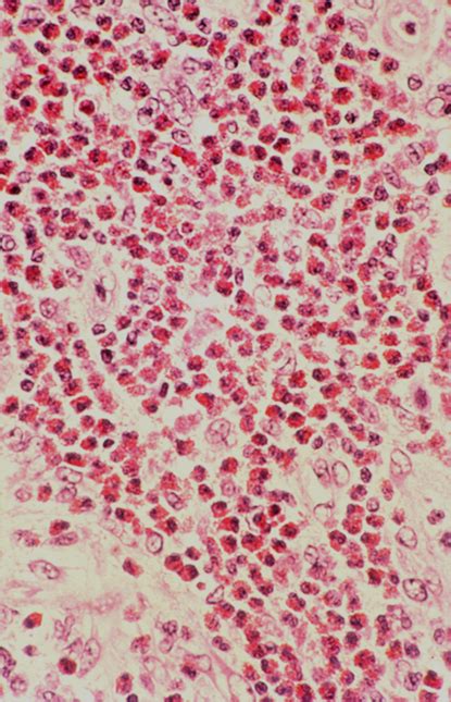 Eosinophilic Granuloma Pathology Orthobullets