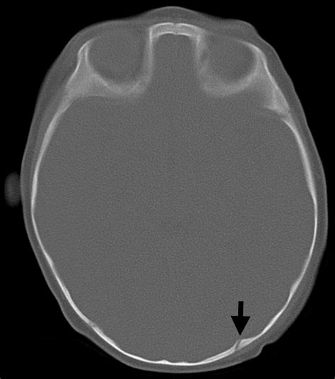 Ct Of Normal Developmental And Variant Anatomy Of The Pediatric Skull