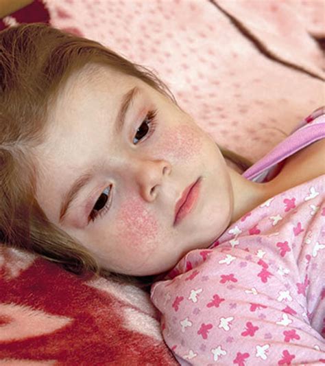 Symptoms And Causes Of Fifth Disease In Children