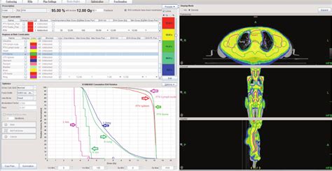 Dose Distribution Maps Of Patient 10 Treated With Tmli The