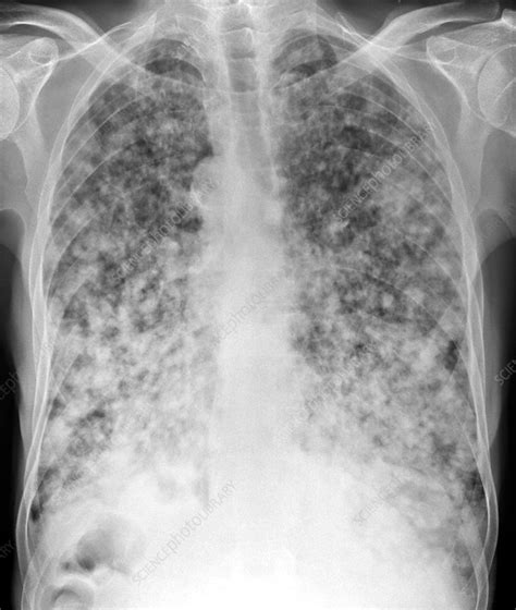 Metastasis of another cancer into the lungs (this is the most common cause of lung cancer in dogs) passive inhalation of smoke in their environment, or second hand smoking living in a suburban area with high levels of pollution Secondary lung cancers, X-ray - Stock Image - C015/4606 ...