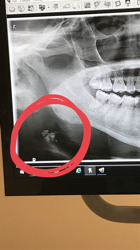 Went To The Dentist Tonsil Stones Showed Up On My X Ray I Dont Even