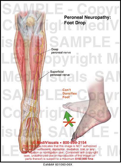 Medivisuals Peroneal Neuropathy Foot Drop Medical Illustration