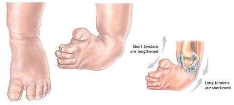 Club Foot Chicago Foot Care Clinic
