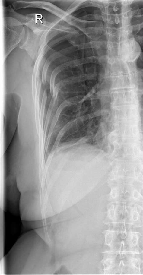 Pneumothorax Due To Rib Fractures Radiology Case Radiopaedia Org Artofit