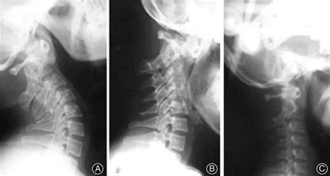 C1 C2 Dislocation On X Ray Before A B And After C Halo Traction