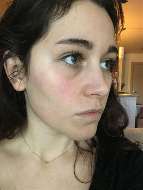 Skin Concerns What Are These Flat Red Dots All Over My Cheeks Skin