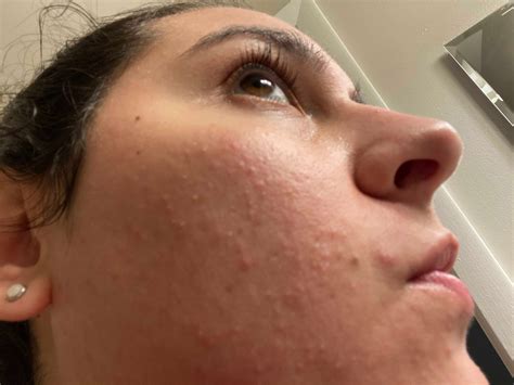 Bunch Of Tiny White Bumps On My Face Beauty Insider Community