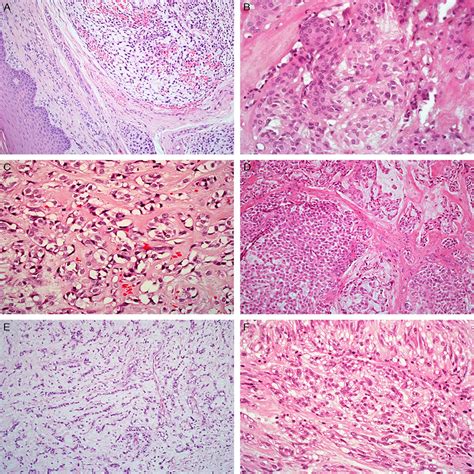 Myoepithelial Tumor Of Soft Tissue Histology And Genetics O