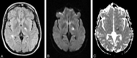 Diffusion Weighted Mr Imaging Characteristics Of An Acute Strokelike