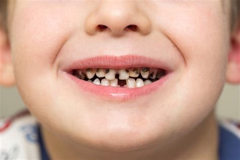 子供の虫歯は親次第 さぁ、はじめよう親子で予防歯科 八潮の歯医者 Lealea歯科・矯正歯科クリニック